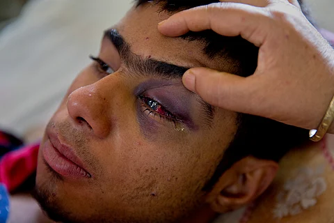 Tabish Bhat, whose eye was damaged after security forces fired pellets at him during a protest. (File | AP)