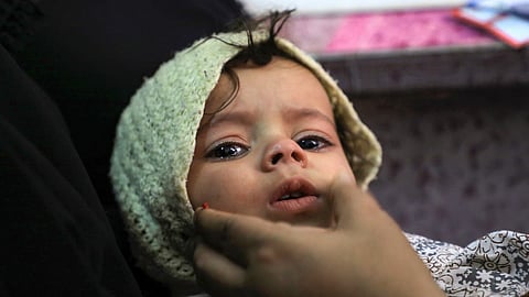 ظهور حالات شلل أطفال باليمن