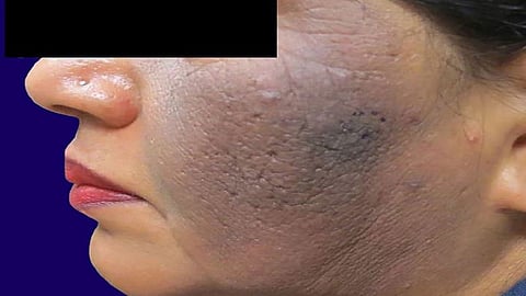 تصبغات جلدية