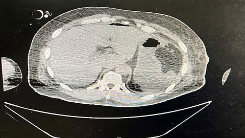 إنقاذ شاب تعرض للإصابة بآلة حادة