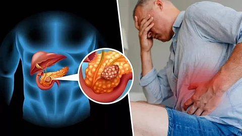 سرطان البنكرياس ـ تعبيرية