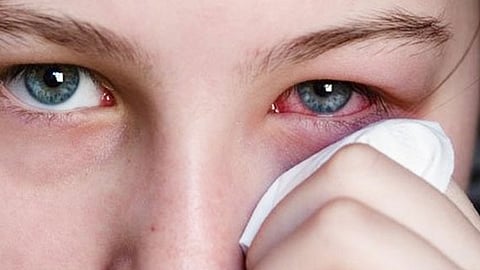 مصابة بمرض التراخوما