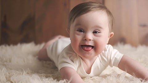 طفل مصاب بمتلازمة داون (أرشيفية)