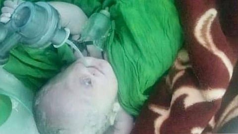 ولادة طفل بعين واحدة