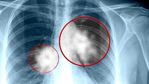 عقار واعد يعالج سرطان الرئة