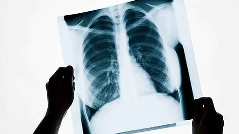 أشعة سينية على المخ