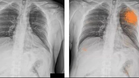 أشعة سينية للرئة