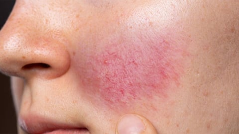 احمرار البشرة المستمر