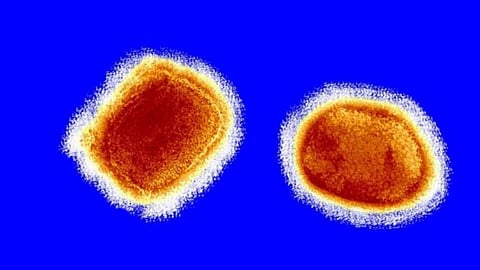 جدري القرود