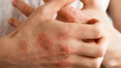 الإصابة بالأكزيما