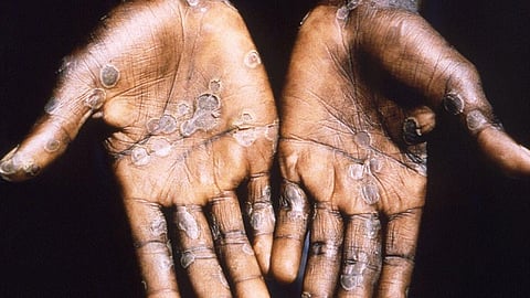 الإصابة بفيروس جدري القرود