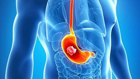 جرثومة المعدة