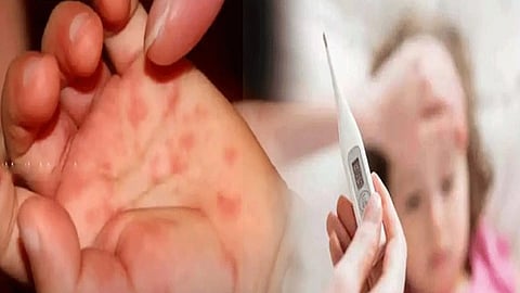 حمى الطماطم