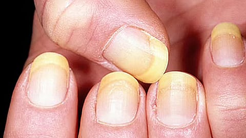 علامات تظهر في الأصابع