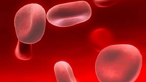 نقص الحديد بالجسم