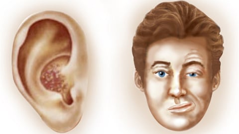 متلازمة رامزي هانت