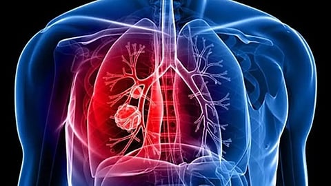 علامات تدل على  الإصابة بالسرطان