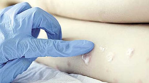 جدري القردة في كوريا الجنوبية