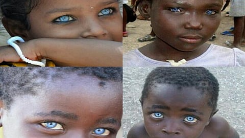 المهق العيني