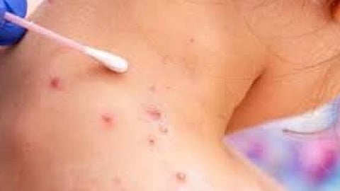 جدري القرود