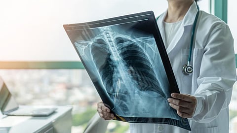 أشعة سينية لمريض سرطان