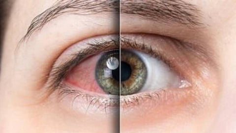 متلازمة جفاف العين