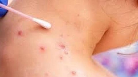 جدري القرود