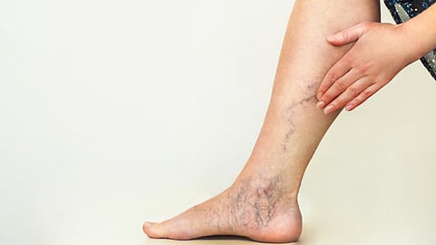 دوالي الساقين