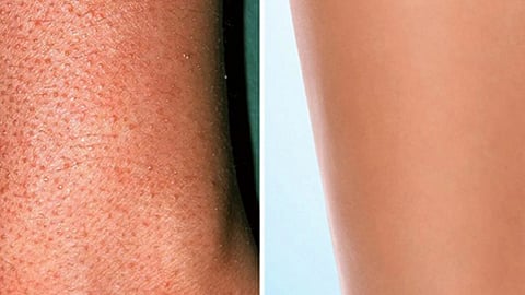 جلد الفراولة