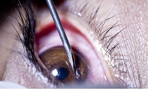 زراعة قرنية اصطناعية