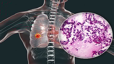 علامة مفاجئة تدل على الإصابة بالسرطان
