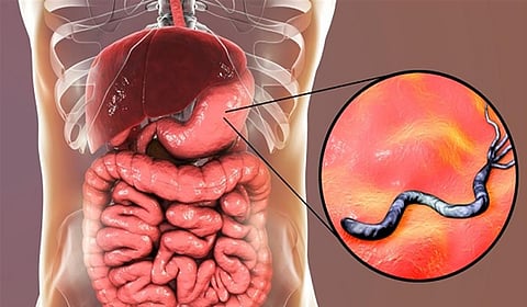 جرثومة المعدة