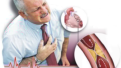 6 أسباب للإصابة بتصلب الشرايين وطرق الوقاية