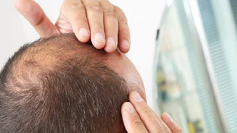 علاج الصلع