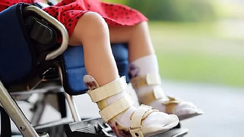 شلل الأطفال