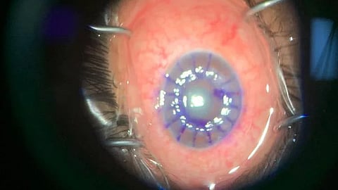 قرنية أحد الأشخاص – أرشيفية