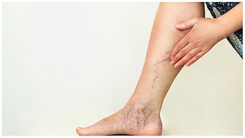 دوالي الساقين