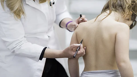 علامات مرض الجنف وطرق علاجه