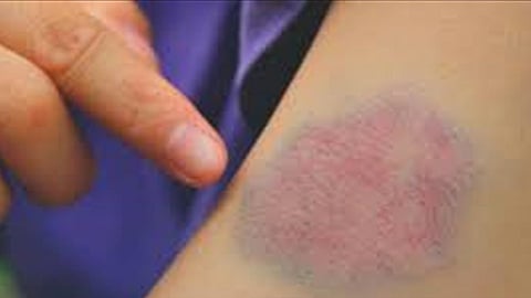 الجلطات الدموية