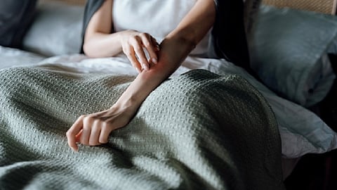 ضرر الأكزيما هذا الشتاء