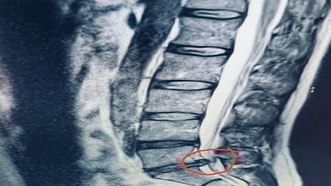 عملية دقيقة أسفل الظهر