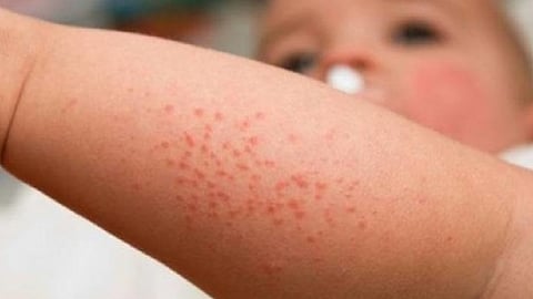 انتشار فيروس حمى غرب النيل بالبعوض