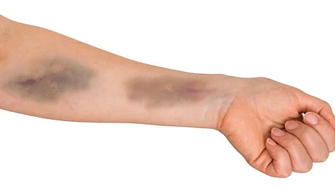 4 أسباب غير متوقعة لظهور الكدمات المفاجئة بالجسم