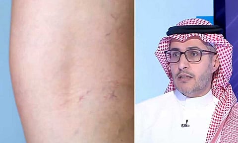 استشاري: الجينات الوراثية أحد أسباب دوالي الساقين.. وهذه الفئة الأكثر عرضة للإصابة