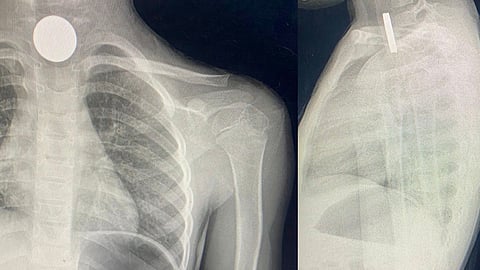 طفلة تبتلع قطعة معدنية بالجوف