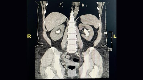 الحصوات المتشعبة بالكلى