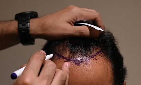 دفع حياته ثمنًا.. شاب هندي يتوفى بعد خضوعه لـ«عملية زرع شعر»