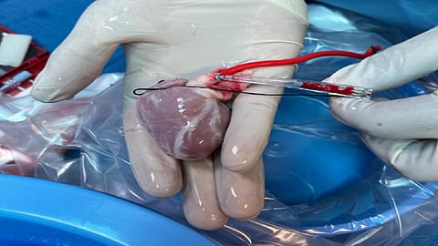 زراعة قلب لأصغر طفلة