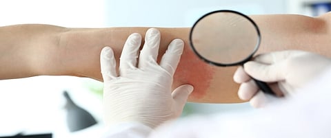 «تخصصي الدمام»: 4 فئات أكثر عرضه للإصابة بالحزام الناري