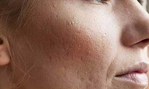 النخالة الوردية